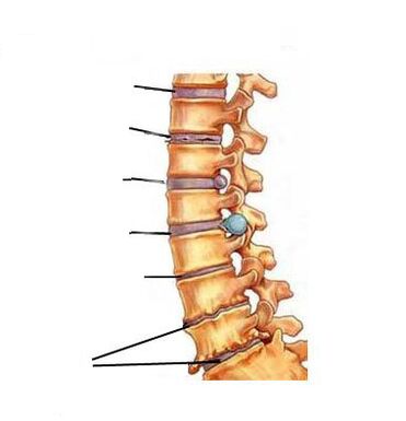 Come si sviluppa l'osteocondrosi