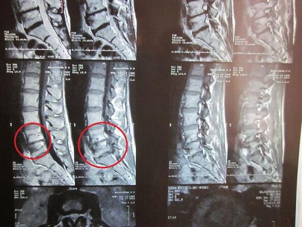 Diagnosi di osteocondosi cervicale