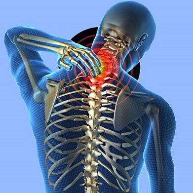 Dolore al collo con osteocondosi cervicale