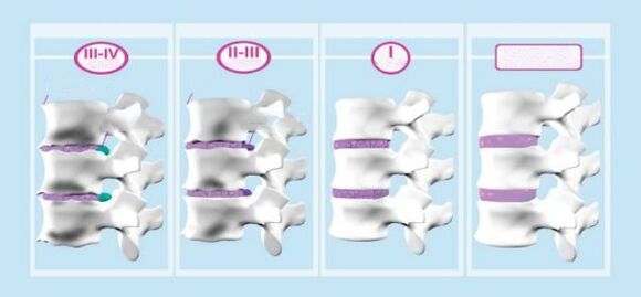 Fase dell'osteocondosi cervicale