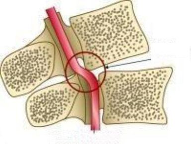 Sindrome dell'arteria Vail