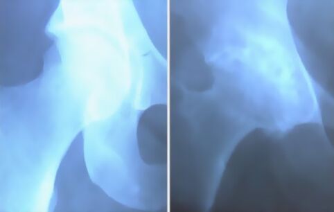 Feccia di artrosi dell'articolazione del ginocchio