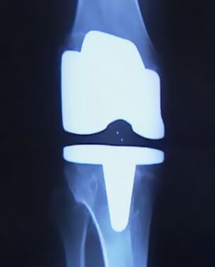 X -raggi immagine del ginocchio con una protesi artificiale dopo l'operazione per cambiare l'articolazione