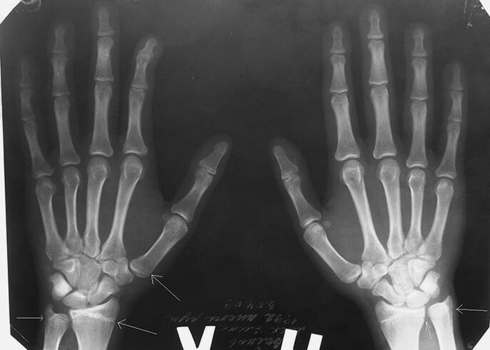 Radiografia per dolore alle articolazioni delle dita