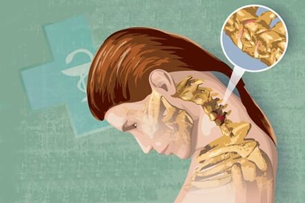 Sintomi riflessi di osteocondosi